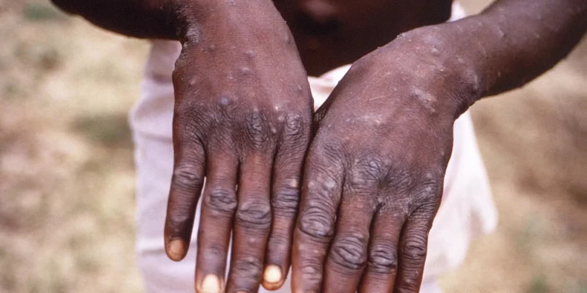 نتائج اختبار “سلبية” لـ3 حالات اشتباه بجدري القرود