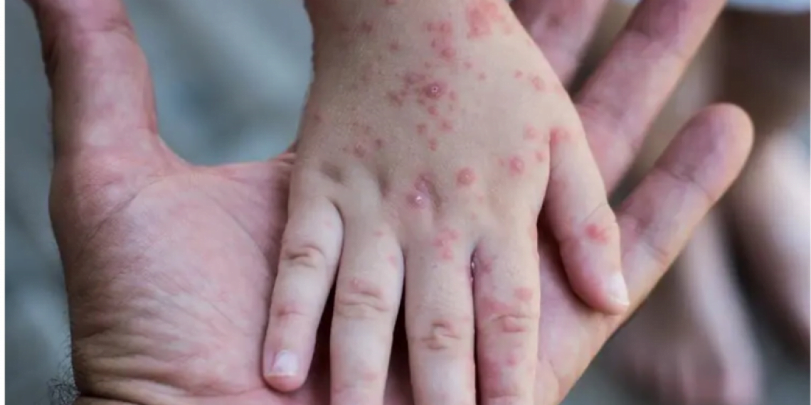 المغرب يعلن خلوه من جدري القردة – صحيفة الرؤية